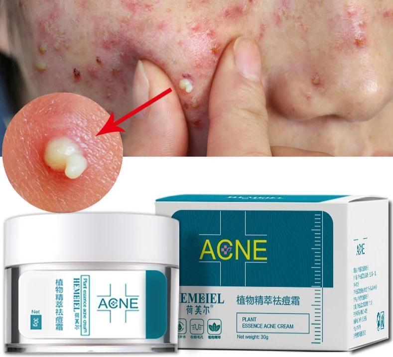 Acne Cream - Zambeel