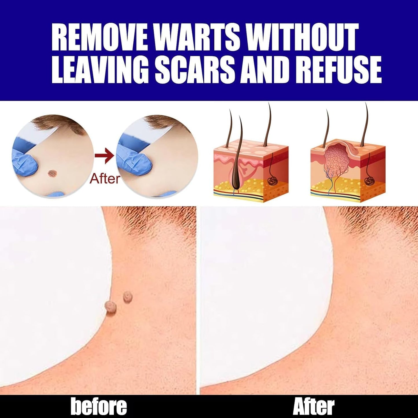 Warts Remover - Zambeel