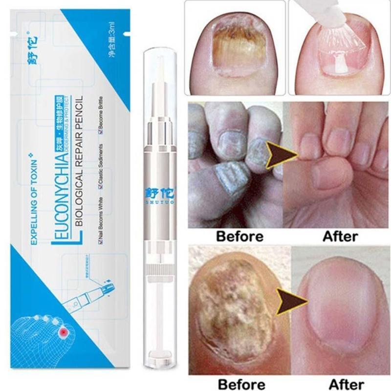 1Pcs Nail Fungal Treatment Pen Anti Fungus Infection Biological Repair Solution Nutritious Oil 3ml Restores Healthy Toenails - Zambeel
