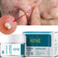 Acne Cream - Zambeel
