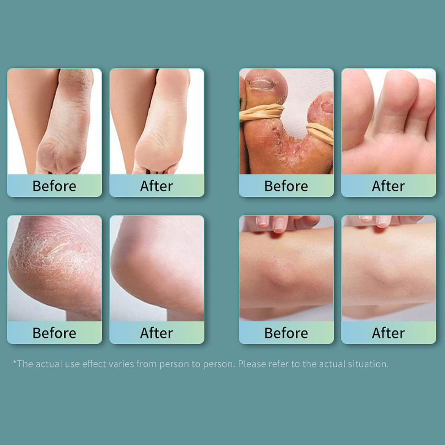 Ansiyi - Foot Bacteria Bacteriostasis Spray (Original) - Zambeel