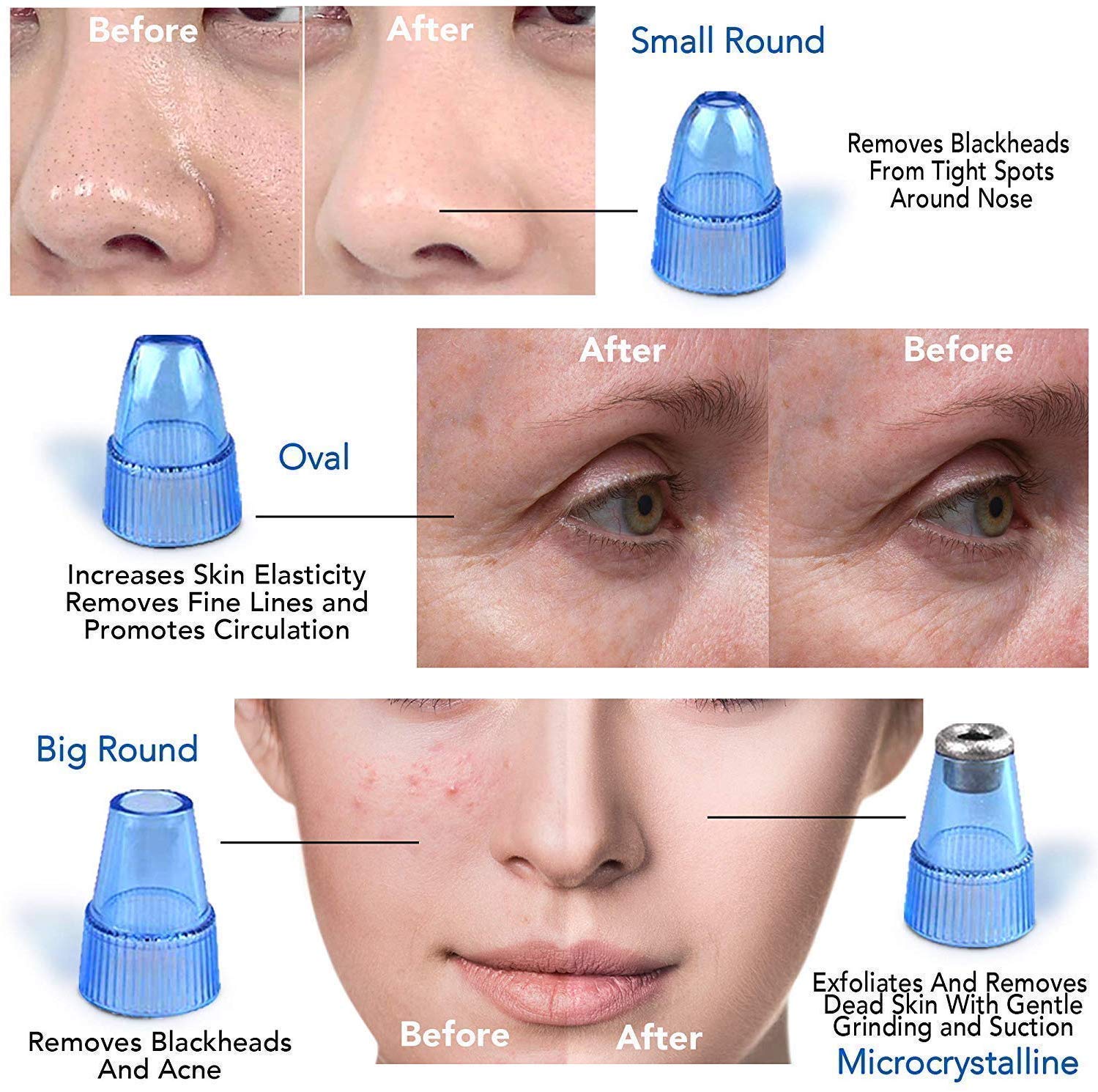 Blackhead Cosmetology Apparatus - Zambeel