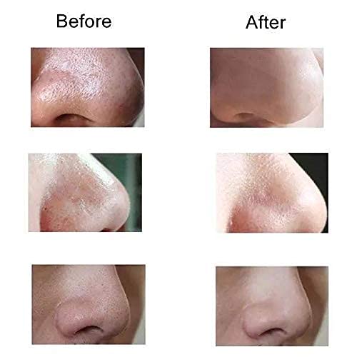 Blackhead Cosmetology Apparatus - Zambeel