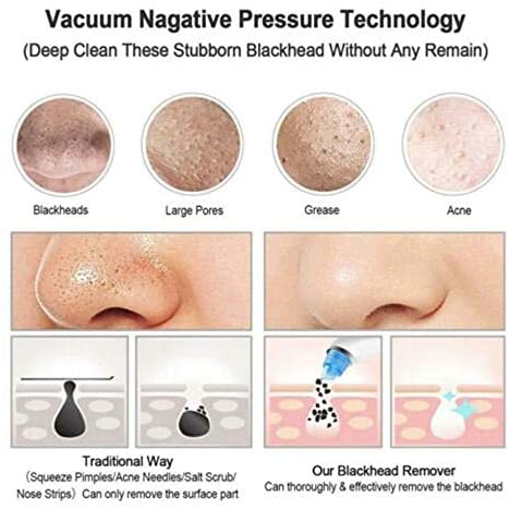 Blackhead Remover - Zambeel