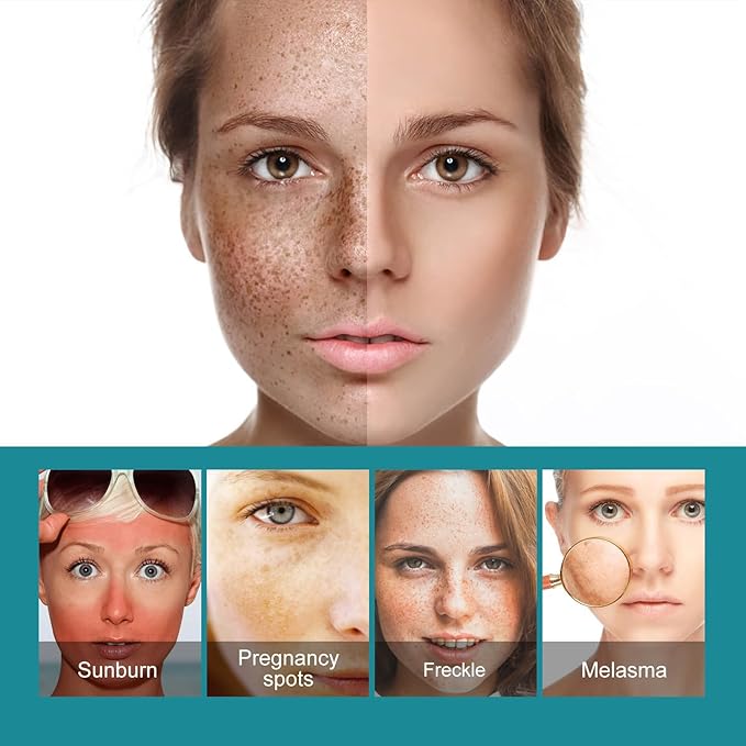 Eelhoe - Dark Spots Removes Cream (Original) - Zambeel