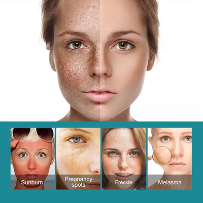 Eelhoe - Dark Spots Removes Cream (Original) - Zambeel