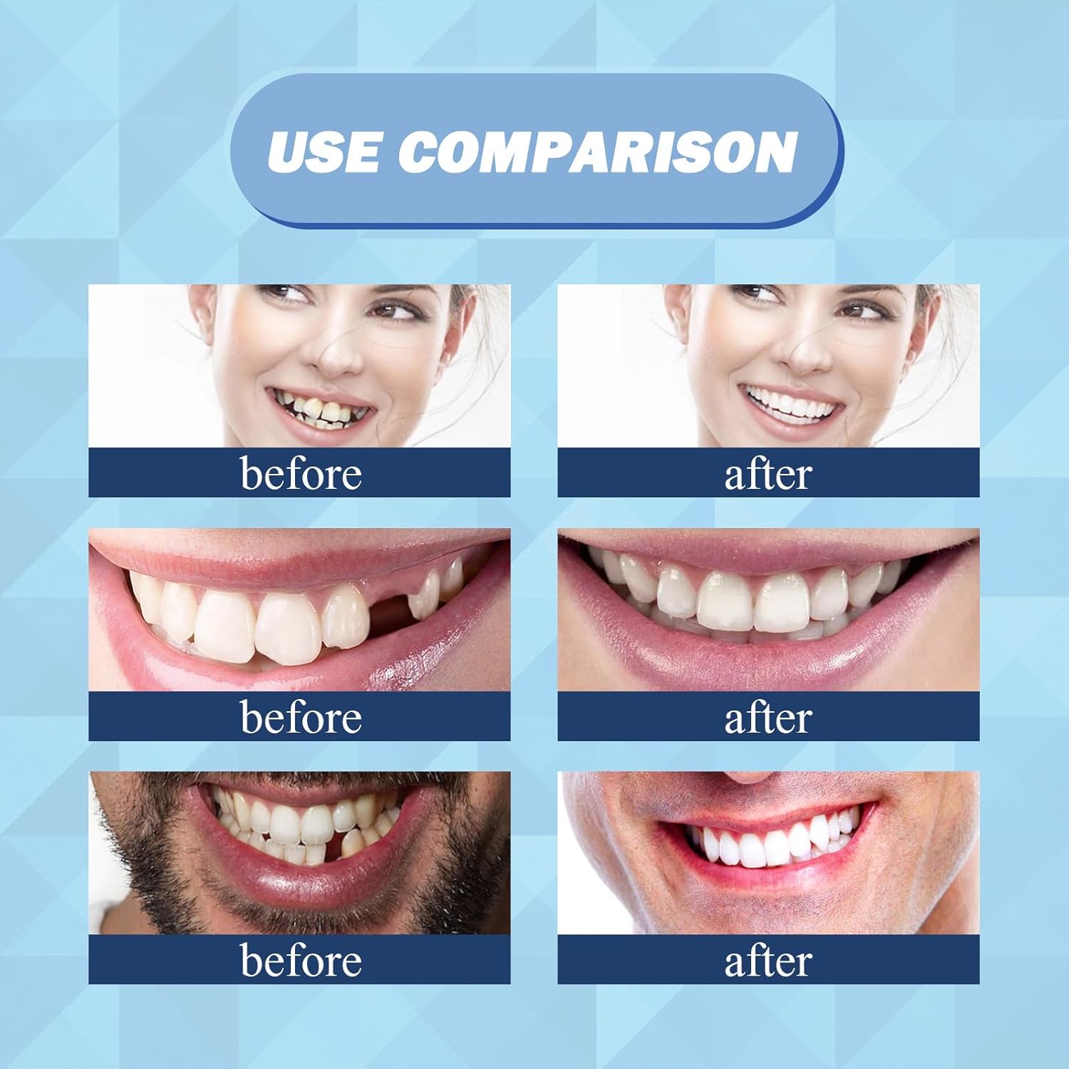 Eelhoe - Thermal Forming False Teeth - Zambeel