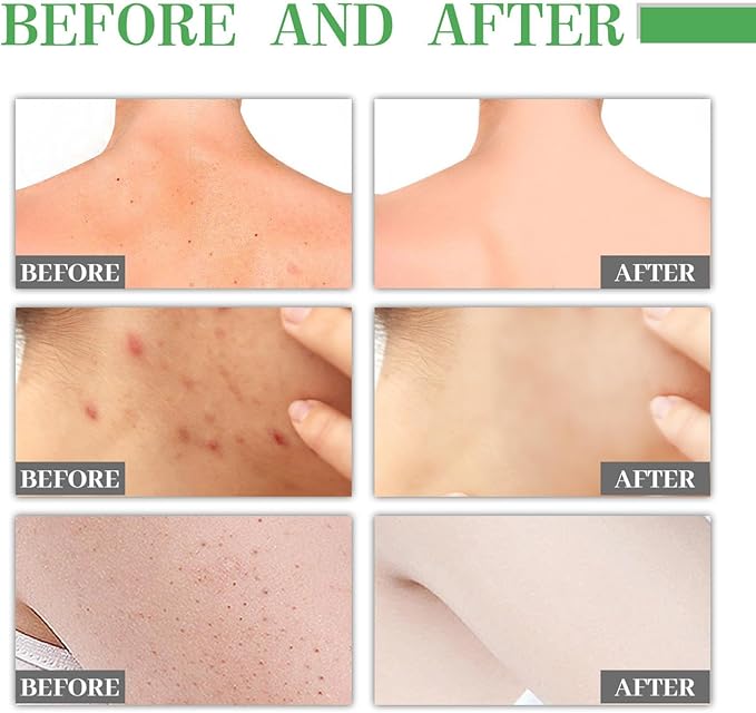 Jaysuing - L ' Body Acne Removing Essence - Zambeel