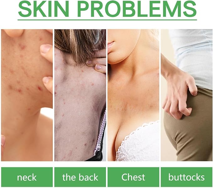 Jaysuing - L ' Body Acne Removing Essence - Zambeel