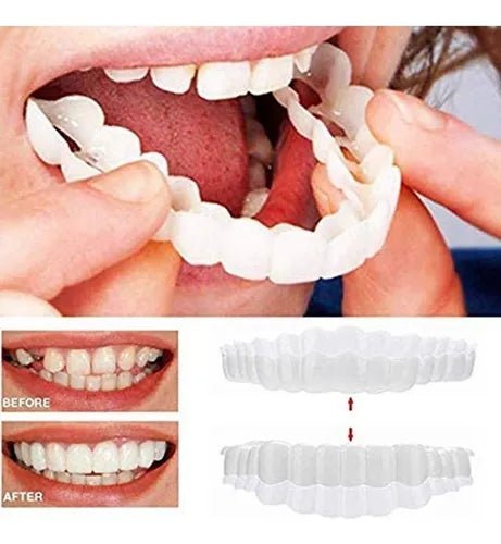 Smile Veneers - Zambeel