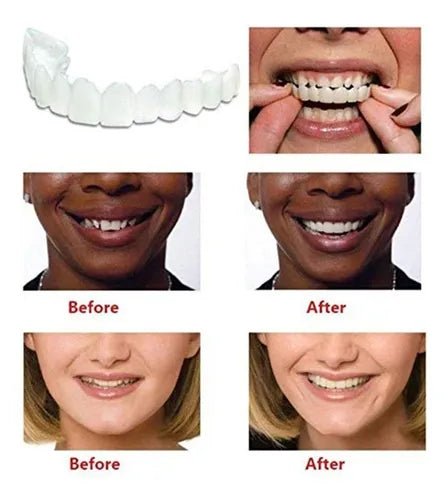 Smile Veneers - Zambeel