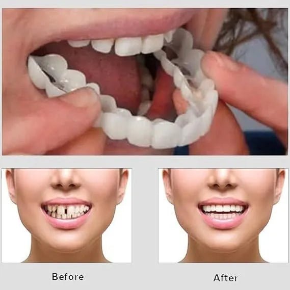 Smile Veneers - Zambeel
