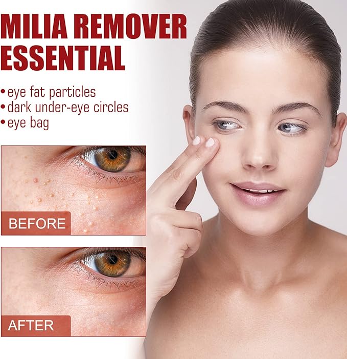 Smooth Milia Remover Serum (30ml) - Zambeel