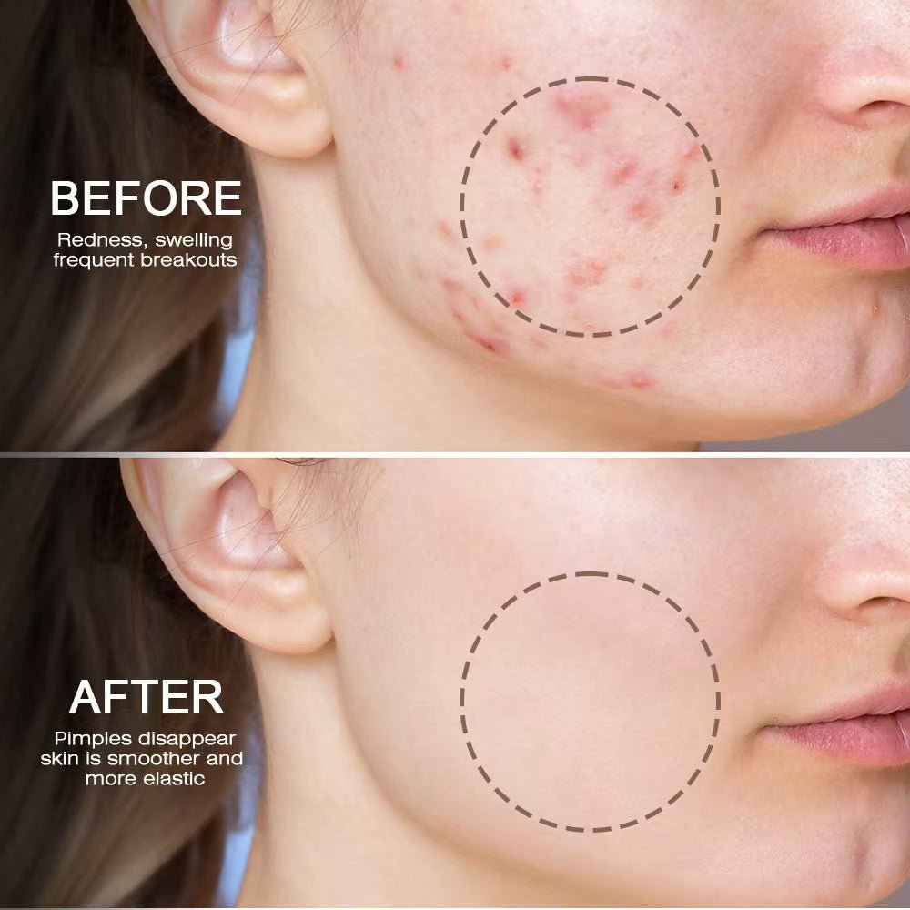 Snmifun - Bee Anti - Acne Gel - Zambeel