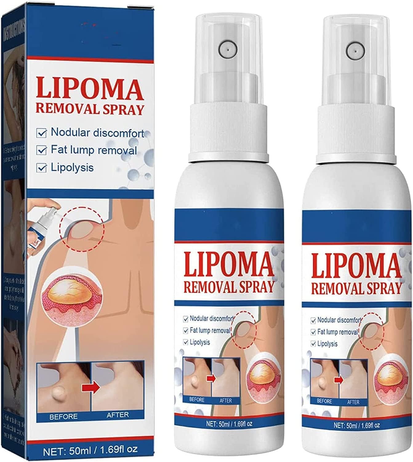 South Moon - Lipoma Removal Spray - Zambeel