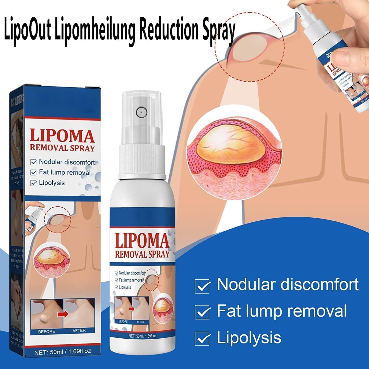 South Moon - Lipoma Removal Spray - Zambeel