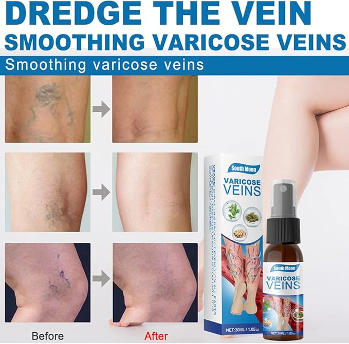 South Moon - Varicose Veins (Original) - Zambeel