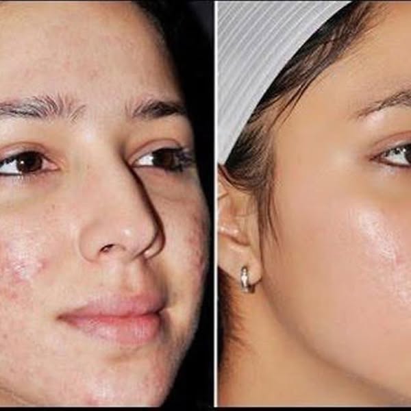 Sumifun - Expigment 4% Cream (Original) - Zambeel