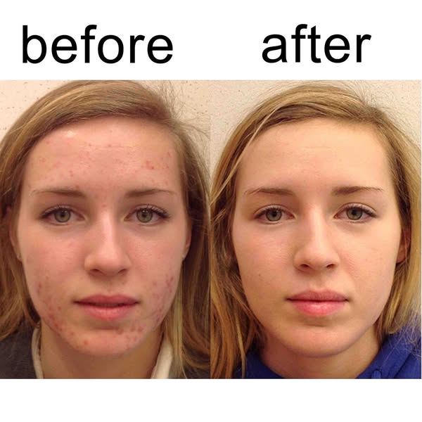 Sumifun - Expigment 4% Cream (Original) - Zambeel