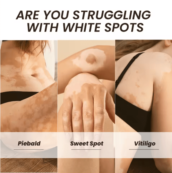 Sumifun - Vitamine Vitiligo Cream (Original) - Zambeel