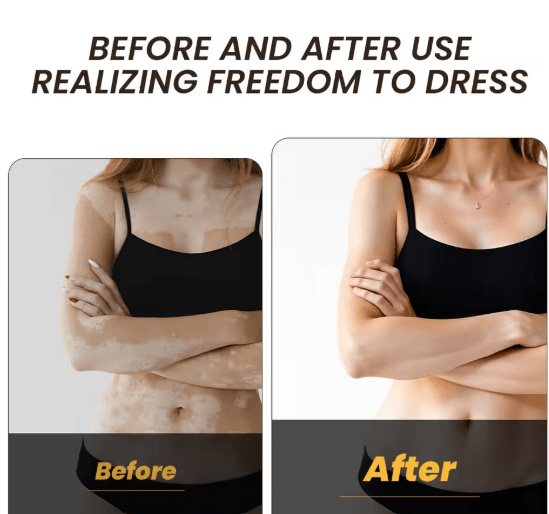 Sumifun - Vitamine Vitiligo Cream (Original) - Zambeel